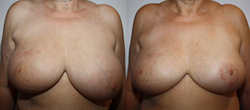 De gauche à droite :  Asymétrie post traitement conservateur du sein droit Après réduction à gauche de 350g