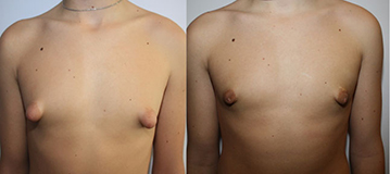 De gauche à droite : Gynécomastie glandulaire et seins tubéreux Résultat post opératoire