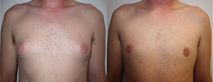 De gauche à droite :  Gynécomastie graisseuse Résultat post opératoire