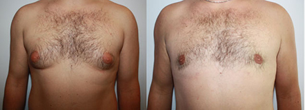 De gauche à droite :  Gynécomastie mixte sans excès cutané  Résultat post opératoire