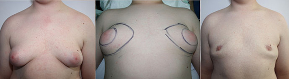De gauche à droite :  Gynécomastie mixte avec excès cutané  Incision périaréolaire  selon Round Block Résultat post opératoire