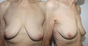 De gauche à droite : Résultat après traitement conservateur d’un cancer externe droit de 20mm Cicatrice discrète sans déformation du sein 