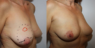 De gauche à droite :  Lésion de 20mm supéro-médiane dans le décolleté  Résultat post opératoire discret  après incision périaréolaire