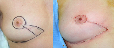 Esquerda para a direita :  localisation inférointerne: exérèse  avec une incision sous mammaire  permettant un lambeau   résultat  per-opératoire  après lambeau cutanéoglandulaire et round block associé