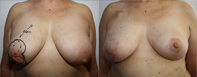 De gauche à droite :  Tumeur rétroaréolaire en préopératoire après chirurgie  et radiothérapie