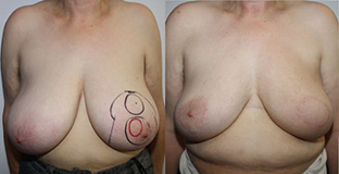 Esquerda para a direita :  Tumeur rétroaréolaire en préopératoire après chirurgie  et radiothérapie