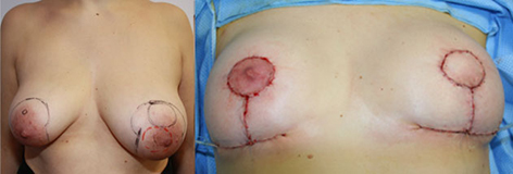Esquerda para a direita : Tumeur rétroaréolaire en préopératoire résultat en fin d’intervention