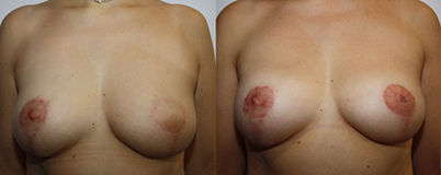 Esquerda para a direita :  après chirurgie  et radiothérapie après reconstruction aréolo-mamelonnaire