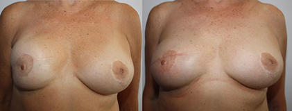 De gauche à droite :  Asymétrie mammaire 7ans après une reconstruction mammaire droite par prothèse 