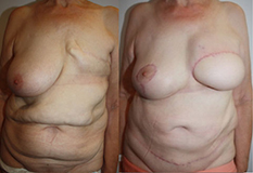 De gauche à droite :<br /> Patiente de 67 ans avec une morphologie adaptée et en très bonne santé<br /> Résultat postopératoire