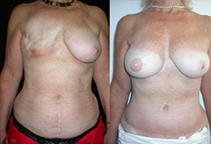 De gauche à droite :  Cicatrice médiane sous ombilicale Reconstruction avec un hémi-TRAM