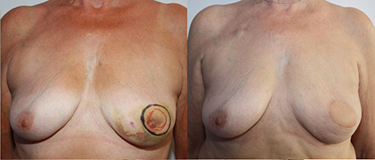 De gauche à droite :  Cancer rétroaréolaire gauche Seins bonnet B Résultat après Grand Dorsal désépidermisé