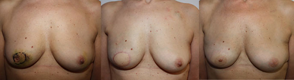 De gauche à droite :  Cancer rétroaréolaire petits seins  Résultat naturel après lambeau de grand dorsal  autologue Résultat final après  reconstruction de l’aréole