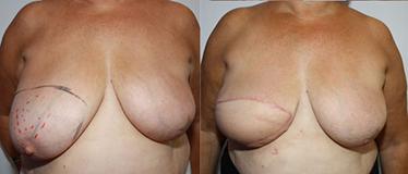 De gauche à droite :  Cancer du sein droit survenu à distance  d’un cancer du sein gauche traité de manière conservatrice Résultat après mastectomie totale et reconstruction immédiate par lambeau de Grand Dorsal autologue
