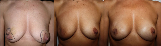 De gauche à droite :<br /> avant, après exérèse de la tumeur et du mamelon, Résultat définitif après radiothérapie et reconstruction du mamelon