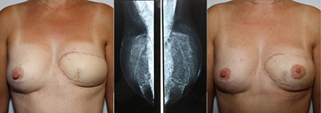De gauche à droite : Sein reconstruit par  TRAM trop petit Mammographie du sein G avant et après Lipofilling Bonne symétrie après lipofilling