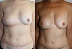 De gauche à droite :  Reconstruction du sein droit par Tram désépidermisé Lipofilling gauche de symétrisation et reconstruction du mamelon droit