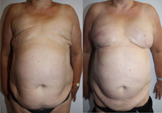 De gauche à droite :  Séquelles de mastectomie bilatérale aspect préopératoire Résultat d’une reconstruction par graisse après 3 séances de Brava