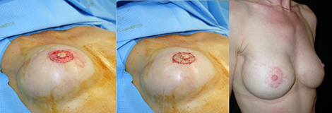 De gauche à droit e: Greffes de l'aréole et du mamelon - Résultat à 6 mois