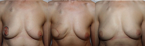 De gauche à droite:<br /> avant, après exérèse de la tumeur et reconstruction immédiate par lambeau de grand dorsal, Résultat définitif après lipofilling et reconstruction du mamelon