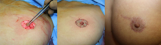 De gauche à droite :  Reconstruction du mamelon par un lambeau local Résultat per opératoire après greffe de l’aréole Résultat à 6 mois