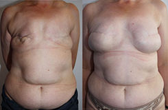 De gauche à droite :<br /> Cicatrice de mastectomie disgracieuse mais absence de radiothérapie<br /> Reconstruction bilatérale satisfaisante avec prothèses