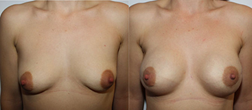 De gauche à droite :  Anomalie BRCA , seins  bonnet B Mastectomie sous cutanée  avec prothèses