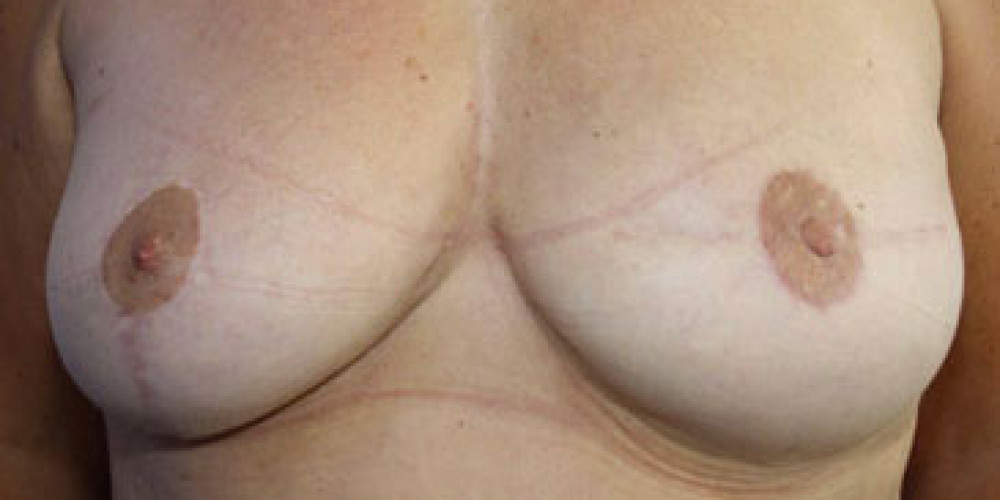 脂肪注射隆乳术