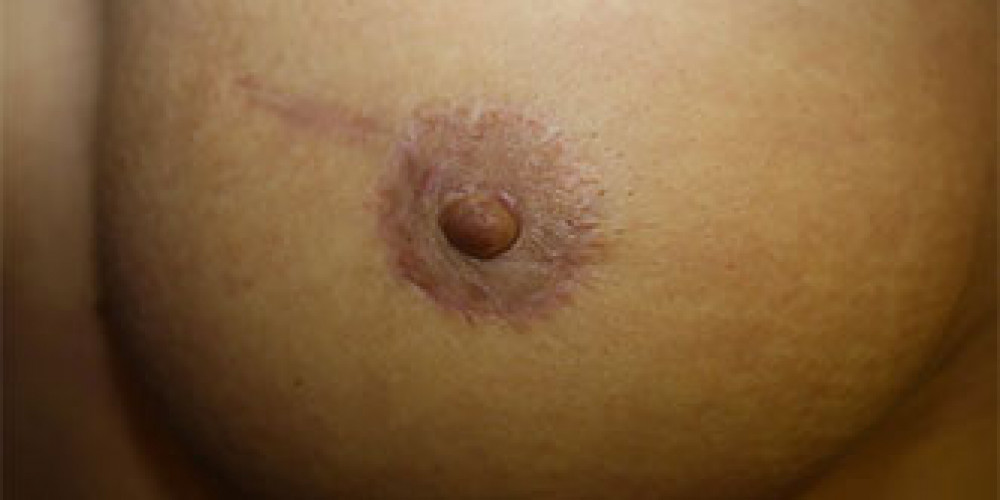 Areola and nipple reconstruction