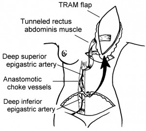 A vascularização do TRAM